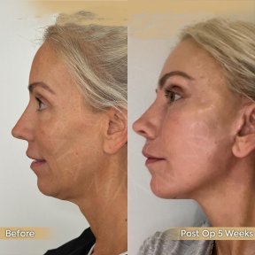 Vorher-nachher-Ergebnis Halsstraffung bei Dr. Safa Manav Clinic, sichtbare Kontur