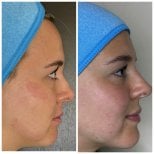 Vorher-nachher-Ergebnisse der Entfernung von Gesichtspigmentierung, klarere Haut