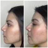 Vorher-nachher-Ergebnis von Botox-Injektionen: glattere Stirn, weniger Falten