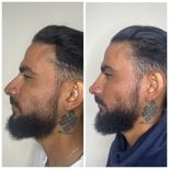 Vorher-nachher-Ergebnis von Botox-Injektionen zur Kieferkontur, sichtbare Verschlankung