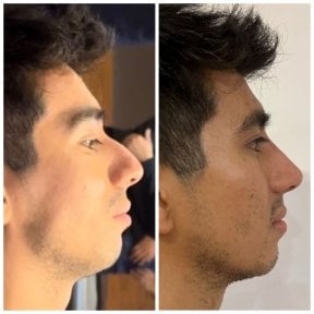 Vorher-nachher-Ergebnis Filler-Rhinoplastik, nicht-chirurgische Nasenkorrektur bei Männern