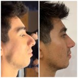 Vorher-nachher-Ergebnis Filler-Rhinoplastik, nicht-chirurgische Nasenkorrektur bei Männern