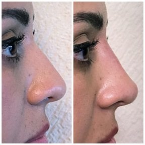 Vorher-nachher-Ergebnis Filler-Rhinoplastik, nicht-chirurgische Nasenkorrektur