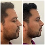 Результати до і після ринопластики філерами, безопераційна корекція носа у чоловіків