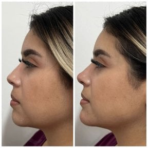 Результати до і після ринопластики філерами, безопераційна корекція носа