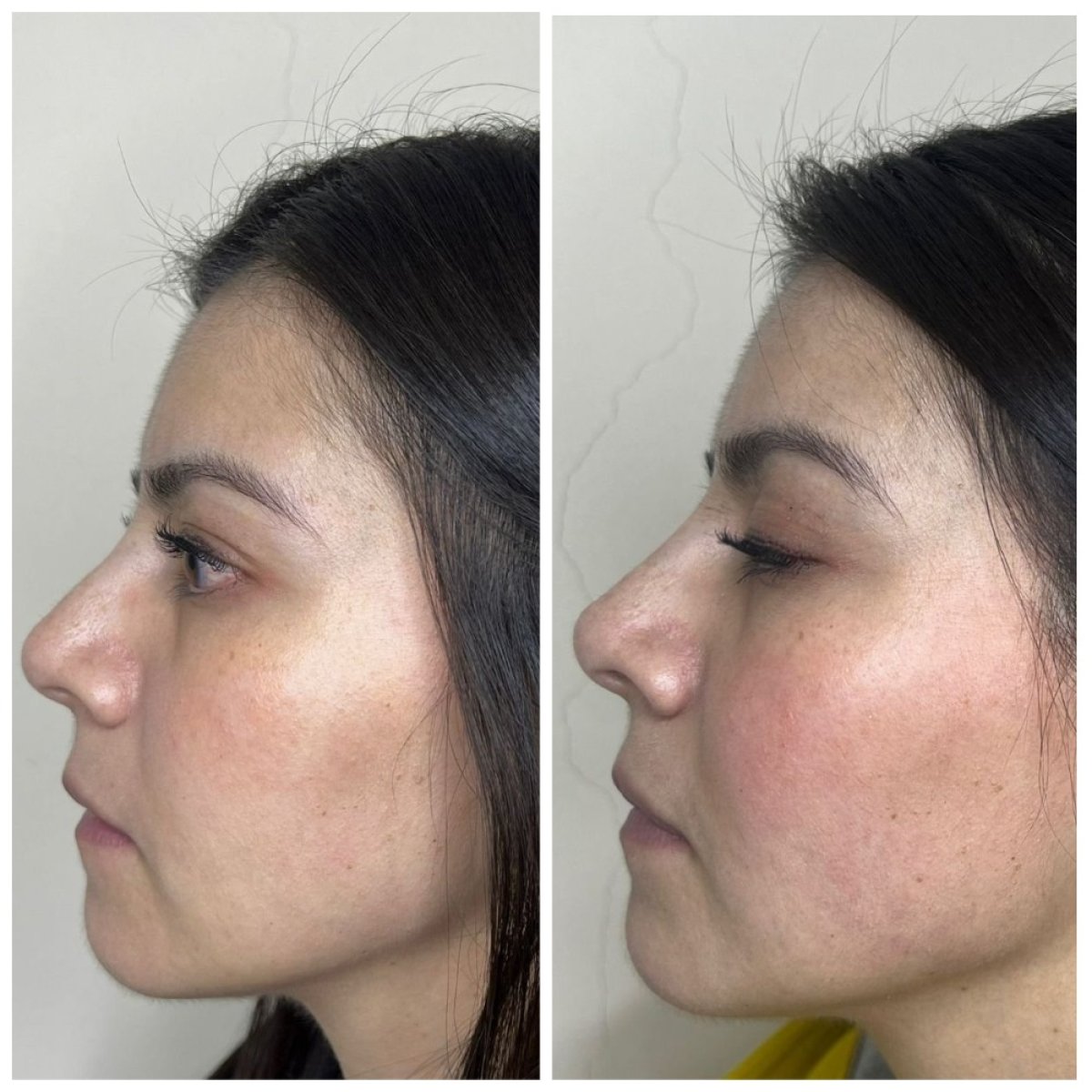 Resultados antes y después de rinoplastia con relleno, remodelación nasal natural