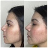 Результати до і після ринопластики філерами, безопераційна корекція носа