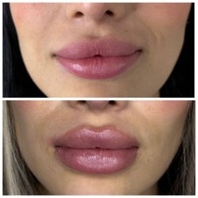 Vorher-nachher-Ergebnis Lippenfiller – mehr Volumen und verbesserte Lippenkontur