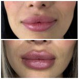 Vorher-nachher-Ergebnis Lippenfiller – mehr Volumen und verbesserte Lippenkontur