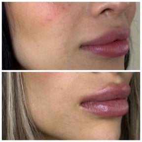 Efekt przed i po wypełniaczach – większa objętość i poprawa konturu ust