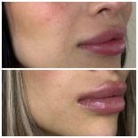Efekt przed i po wypełniaczach – większa objętość i poprawa konturu ust