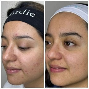 Vorher-nachher-Ergebnis chemisches Peeling – klarere, glattere Haut nach Aknebehandlung