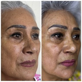 Vorher-nachher-Ergebnis chemisches Peeling, verbesserte Hautstruktur bei reifer Frau