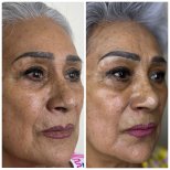 Vorher-nachher-Ergebnis chemisches Peeling, verbesserte Hautstruktur bei reifer Frau