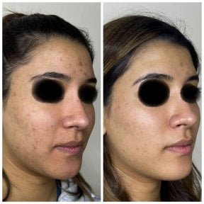 Vorher-nachher-Ergebnis chemisches Peeling – klarere, glattere Haut nach Aknebehandlung
