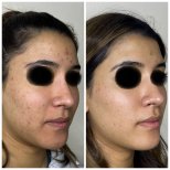 Vorher-nachher-Ergebnis chemisches Peeling – klarere, glattere Haut nach Aknebehandlung