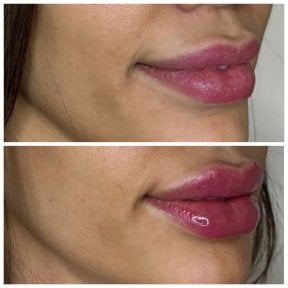 Efekty przed i po powiększaniu ust wypełniaczami – większa objętość i lepszy kontur