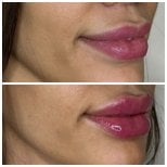 Efekty przed i po powiększaniu ust wypełniaczami – większa objętość i lepszy kontur
