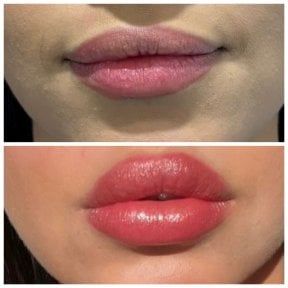 Efekty przed i po powiększaniu ust wypełniaczami – większa objętość i kontur