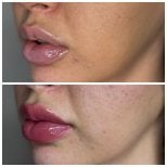 Efekt przed i po wypełniaczach – większa objętość i poprawa konturu ust