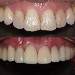 Before and after dental veneers at Yonsei Uline Dental Clinic, smile makeover results