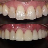 Before and after dental veneers at Yonsei Uline Dental Clinic, smile makeover results