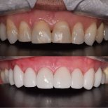 Before and after dental veneers at Yonsei Uline Dental Clinic, smile makeover result