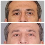 نتائج رأب الجفن السفلي قبل وبعد في Quartz Hospital، تقليل الانتفاخات تحت العين