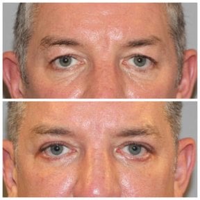 نتائج شد الجفن السفلي قبل وبعد في Quartz Hospital، تقليل الانتفاخات تحت العين