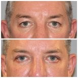 نتائج شد الجفن السفلي قبل وبعد في Quartz Hospital، تقليل الانتفاخات تحت العين