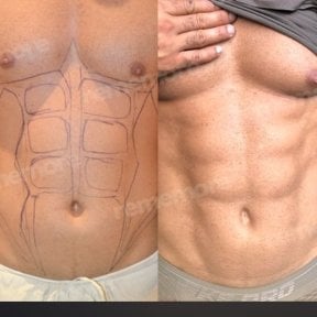Before and after abdominal etching results at Memorial Şişli Hospital, defined six pack abs