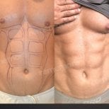 Before and after abdominal etching results at Memorial Şişli Hospital, defined six pack abs