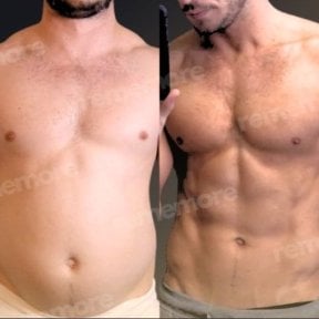Before and after abdominal etching results at Memorial Şişli Hospital, defined six pack abs
