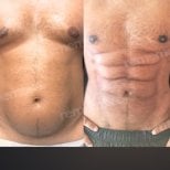 Before and after abdominal etching results at Memorial Şişli Hospital, defined six pack abs
