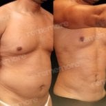 Before and after abdominal etching results at Memorial Şişli Hospital, defined six pack abs