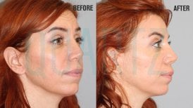 صور قبل وبعد تجاعيد البوتوكس للدكتور 