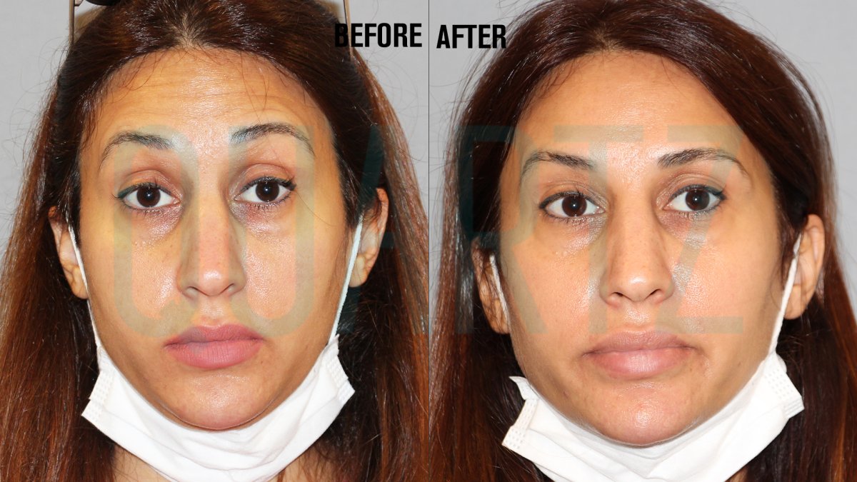 Antes y después de inyecciones de bótox en Quartz Hospital, frente más lisa y piel suave