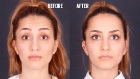 صور قبل وبعد تجاعيد البوتوكس للدكتور 