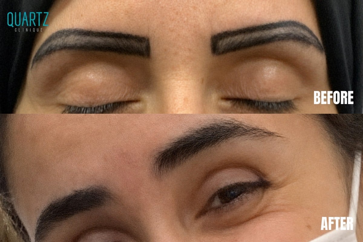 Resultados de trasplante de cejas antes y después en Quartz Hospital, restauración natural