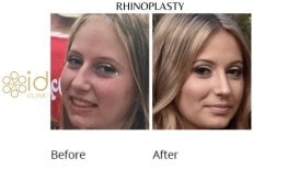 Before and after Rhinoplasty (nose job) photos by Dr. 