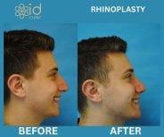 Before and after Rhinoplasty (nose job) photos by Dr. 