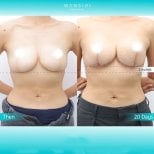 Vorher-nachher-Ergebnis Bruststraffung bei Wansiri Hospital, verbesserte Brustform