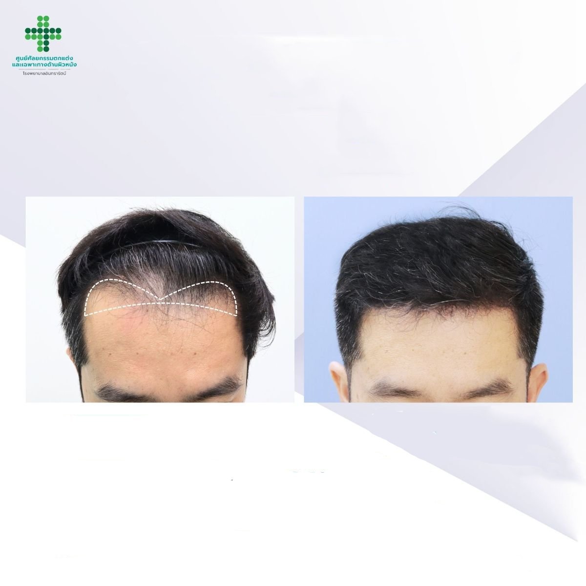 نتائج زراعة الشعر FUE قبل وبعد في مستشفى إنترارات، كثافة خط الشعر المحسنة