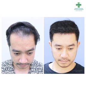 Результати до і після пересадки волосся FUE в Intrarat Hospital з густою лінією росту