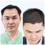 Результати пересадки волосся FUE до і після в Intrarat Hospital, покращена лінія росту