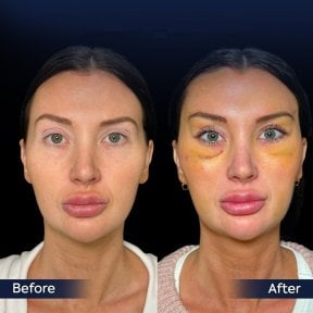 Facelift Vorher-Nachher-Ergebnisse in der Dr. Safa Manav Klinik, sichtbare Verjüngung