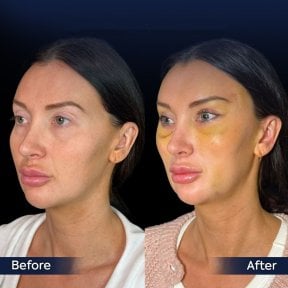 Facelift before and after results at Dr. Safa Manav Clinic, visible facial rejuvenation