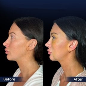 Facelift before and after results at Dr. Safa Manav Clinic, visible facial contour improvement