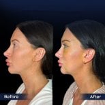 Facelift before and after results at Dr. Safa Manav Clinic, visible facial contour improvement