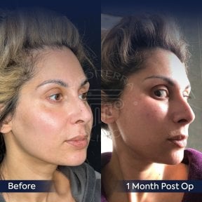 Facelift before and after results at Dr. Safa Manav Clinic, visible facial contour improvement